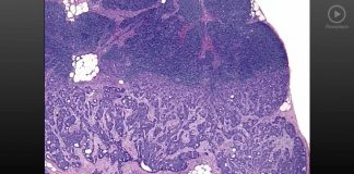 3-5 Tumor Progression