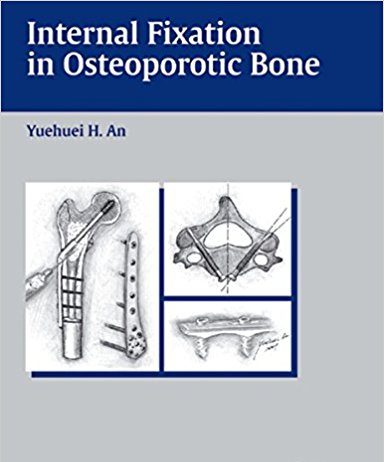 Internal Fixation in Osteoporotic Bone 1st Edition