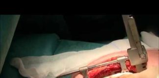 Skeletonized internal mammary artery harvest with diathermy and cold dissection