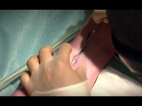 Conventional Open Harvesting of the Great Saphenous Vein