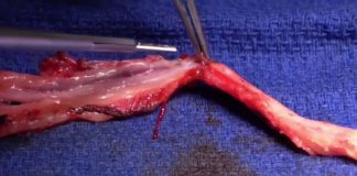 open radial artery harvesting