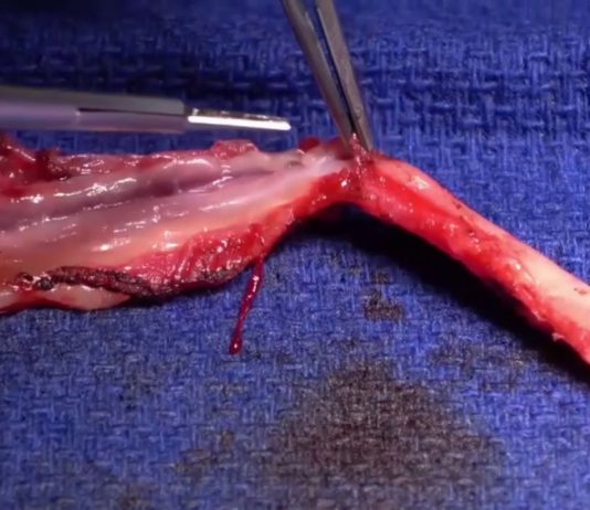 Open radial artery harvesting open radial artery harvesting