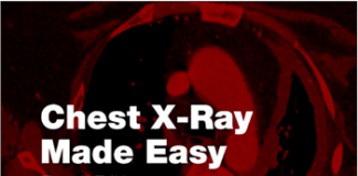 Chest X-Ray Made Easy 4th Edition