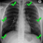 correct-inclusion-chest-x-ray