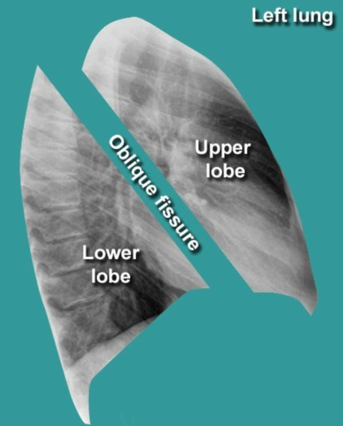 Chest Xray Anatomy How To Interpret Chest xray CtsQena