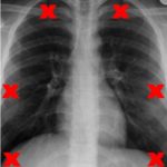 wrong-inclusion-chest-xray
