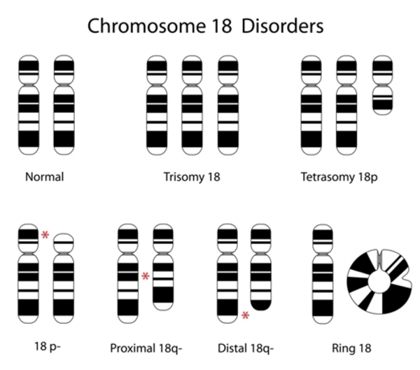 18q deletion syndrome